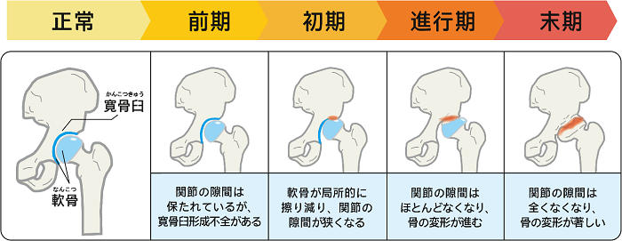 変形性股関節症の治療 | 山中病院 東京都杉並区南荻窪ある病院